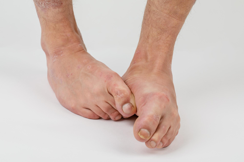 Disorders of Foot