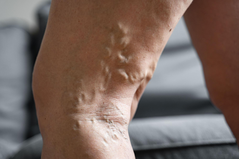 Varicose Vein